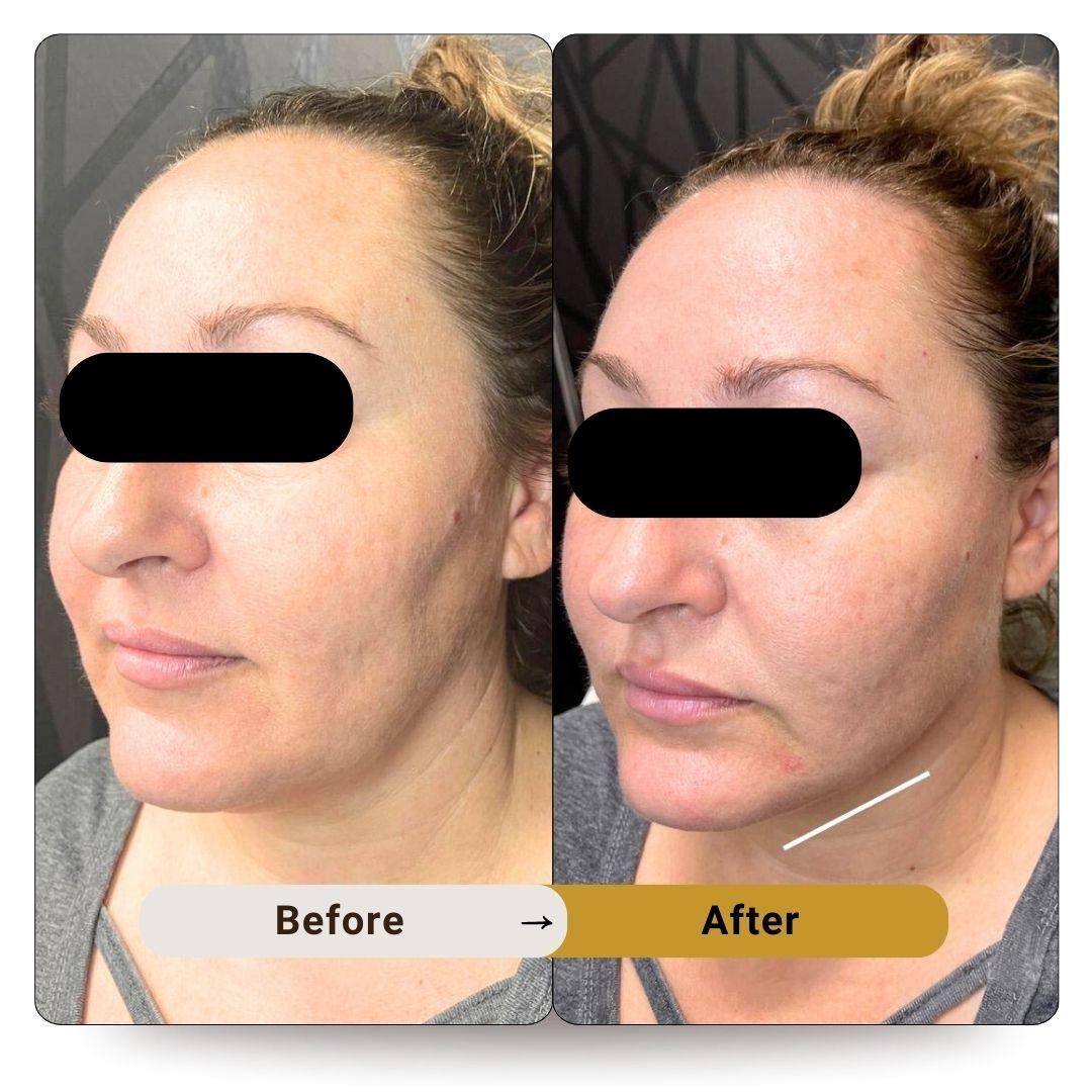 Thread Face Lift Dubai | Elite Body Home Aesthetic Clinic