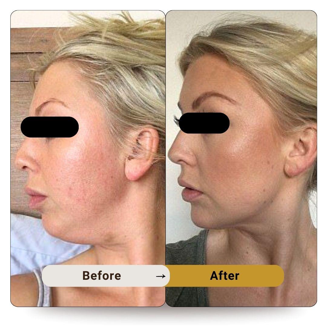 Facial Rejuvenation Treatment by Threads | Elite Body Home