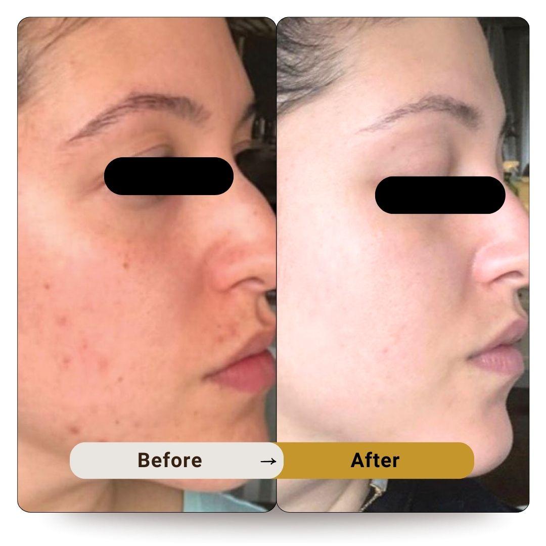 Scars Removal -